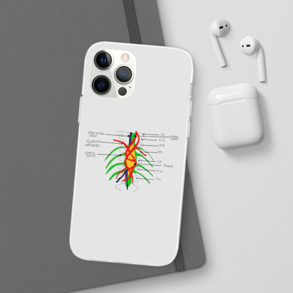 Tumor on the Wall Phone Case