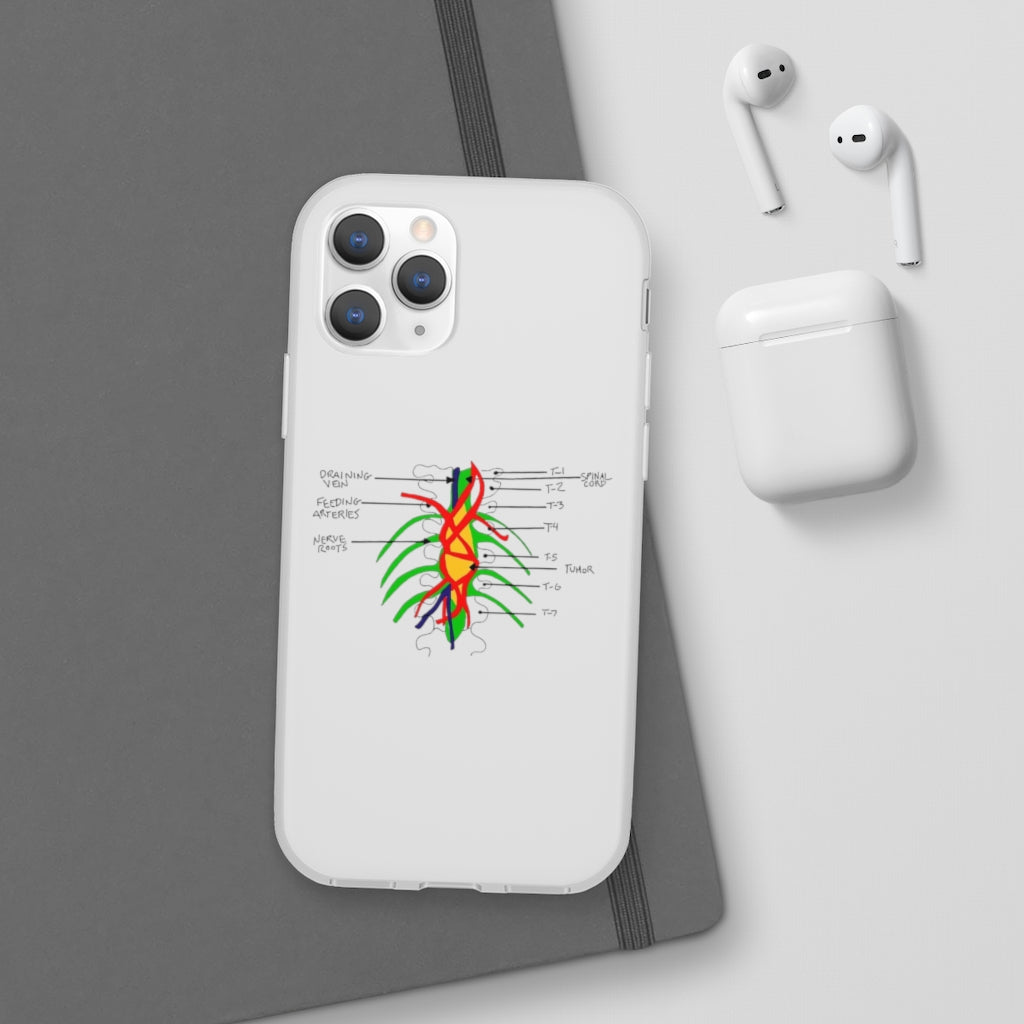 Tumor on the Wall Phone Case